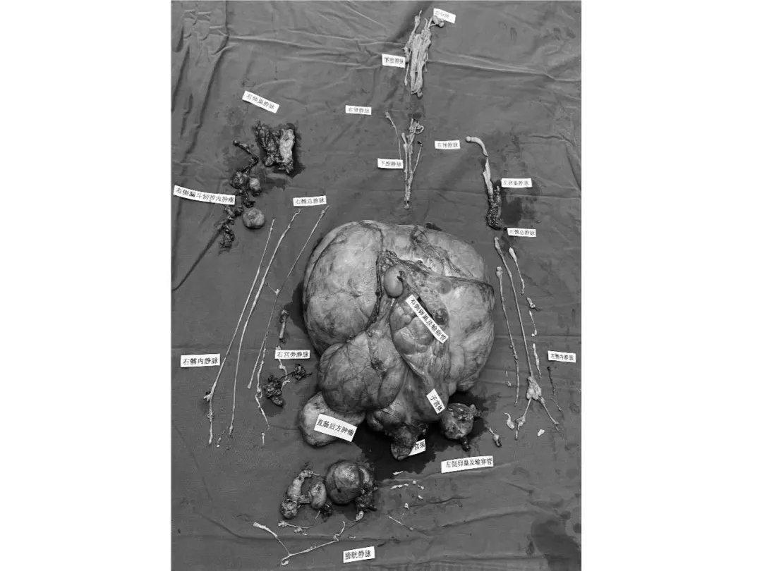 血管|“子宫肌瘤”9斤重，顺着血管长进心脏，14个学科联手，16个小时成功摘瘤