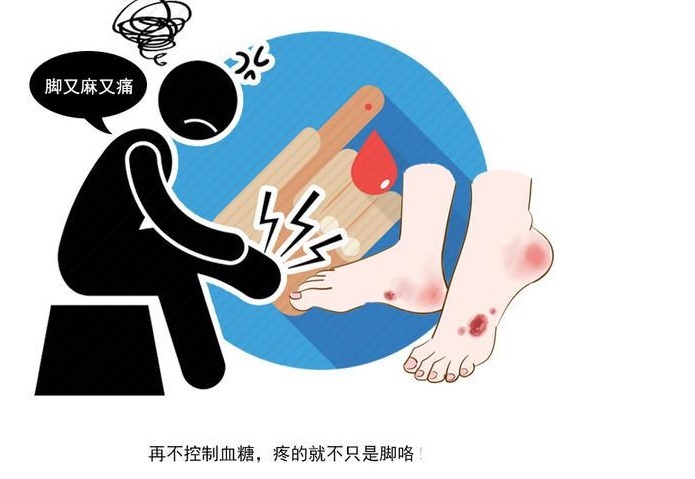 神经末梢|糖尿病患者谨防“烂脚”,建议做好3点,避免患上糖尿病足