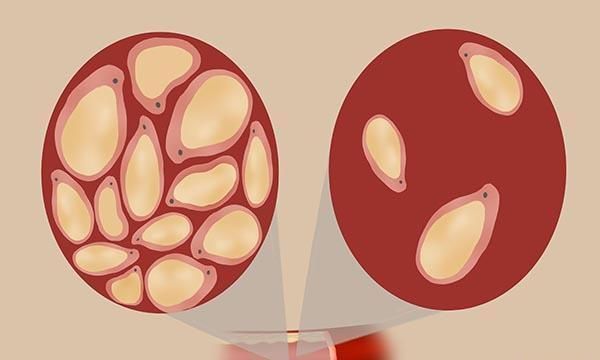  方针|查出甘油三酯104，表示什么医生坚持三个方针，轻松降下去