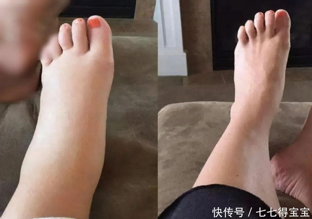 孕妇为什么会水肿?该如何改善水肿的问题?孕妈早知道能少受罪