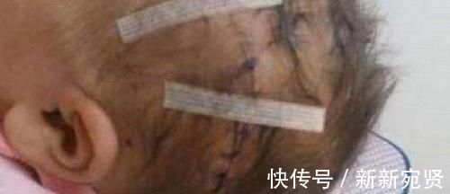 顺产|剖腹产划伤孩子头部,医生很快就会好的,7年后家长找上医院