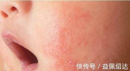 睡眠时间|宝宝湿疹影响孩子睡眠,这些方法,让孩子湿疹期间也能有好睡眠