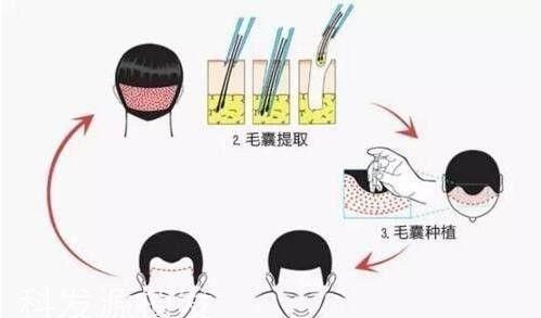 种植|天生发际线高还有救吗?试试发际线补发和自体头发种植,非常实用