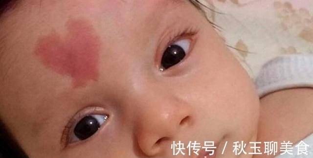 胎记|18岁女孩因为脸上的胎记,选择结束生命,胎记到底是怎么形成的