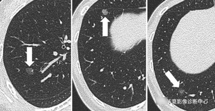 患者|从肺结节到肺癌，10个月影像记录，提醒我们正确对待肺结节处理