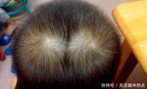 实验|为什么有的孩子头上有2个“旋”有关发旋的误解,你知道多少!