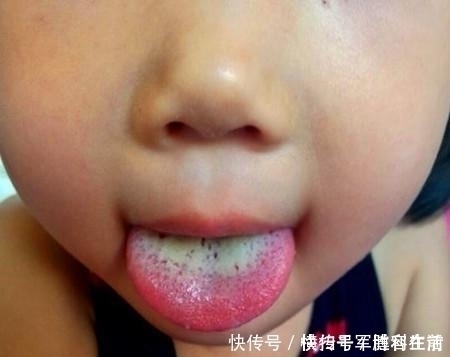 舌苔|6岁女娃，便秘2周不拉，儿科主任再拖，孩子就停止发育了