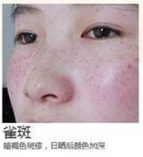 色斑 各类色斑问题如何对症下药,医美祛斑干货!