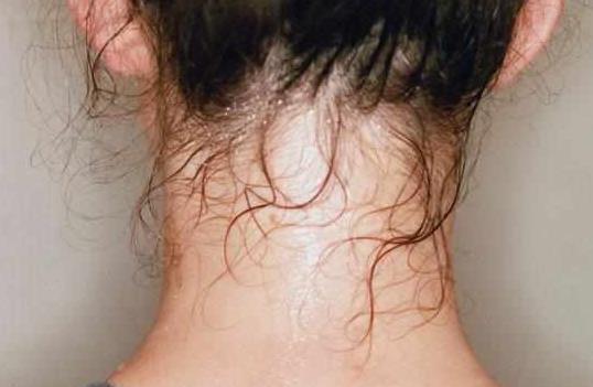 晕眩症|医生:出汗并不等于排毒!小心几种“汗”,可能是疾病的警告