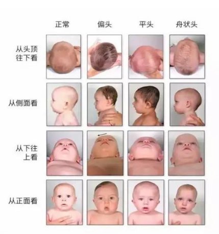 新生|新生宝宝头型不正，既影响智力又影响颜值，你家宝宝什么头型？