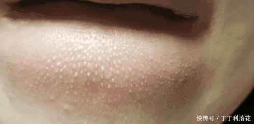 嘴角的下巴总是有白色的痘痘,且还连成一片,是螨虫吗
