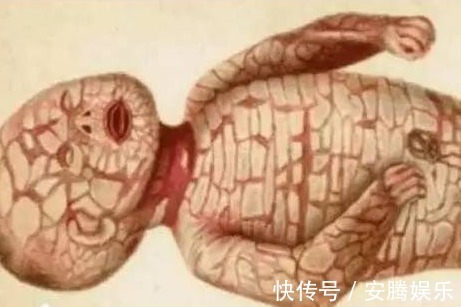 鱼鳞癣|5岁男孩,全身长满“鱼鳞”,父母天天为其刮鳞,大开眼界