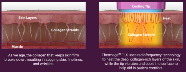 查询|动辄上万的热玛吉，究竟值不值？