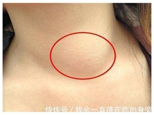 淋巴液|体内有肿瘤,看脖子就知道?脖子有这2种“迹象”,说明出问题了