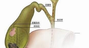 害怕|很多人害怕胆结石,那什么样的人容易得胆结石呢?