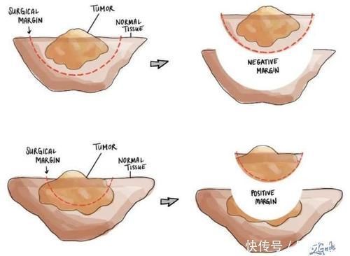 肿瘤|手术后癌症病人怎么知道肿瘤是不是切干净了？