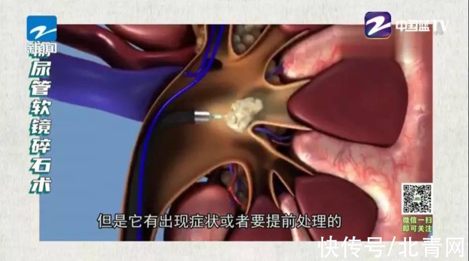 肾绞痛|肾结石究竟是如何形成的？医生劝告：4个诱因及时避开，切莫贪嘴多吃
