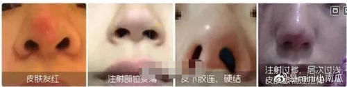 鼻小柱 隆鼻失败症状＆隆鼻失败修复时间＆手术方法解析