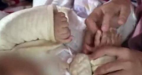 多指症|3个月大的男婴为何长出31根指头?得知原因后母亲崩溃痛哭