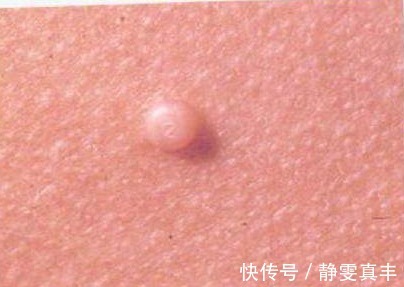 肉疙瘩|身上为什么会长出小肉疙瘩身体在向你表达什么呢