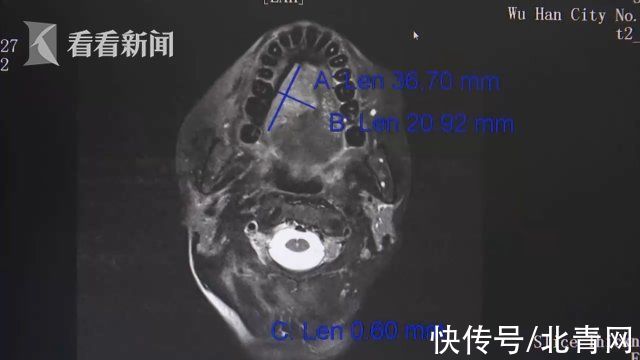 口腔溃疡|女子反复口腔溃疡确诊舌癌 这几类人千万要当心