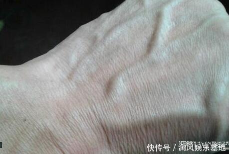 剧烈运动|手上青筋越明显说明身体越差?今天就给大家科普一下!