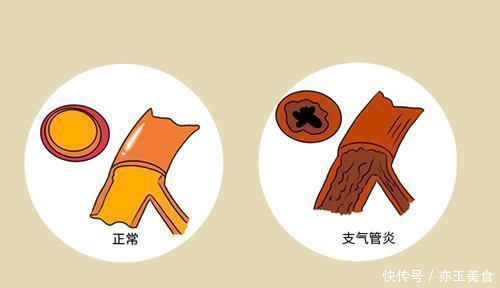 天天咳嗽,做肺部CT又显示正常,是什么原因答案告诉你