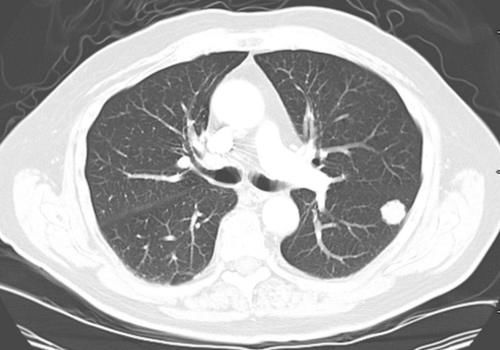 结节|患有肺结节的人,能吃豆制品吗?提醒:不妨多吃2物,或有所改善
