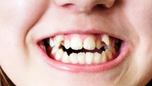 牙医|孩子换牙齿,新长的牙齿却是歪的,可能是家长这些没做好