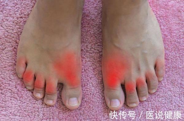 海鲜|痛风发作,不良习惯和饮食只是导火索,了解后,才能有效预防