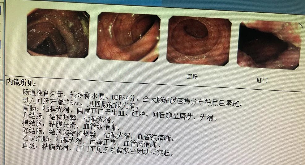 泻药|悔不当初，男子肠子粗得碗口大，全因常吃泻药