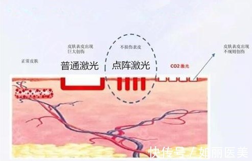 欧洲 co2点阵激光和欧洲之星哪个好？区别科普+优势解析，医美不盲目！