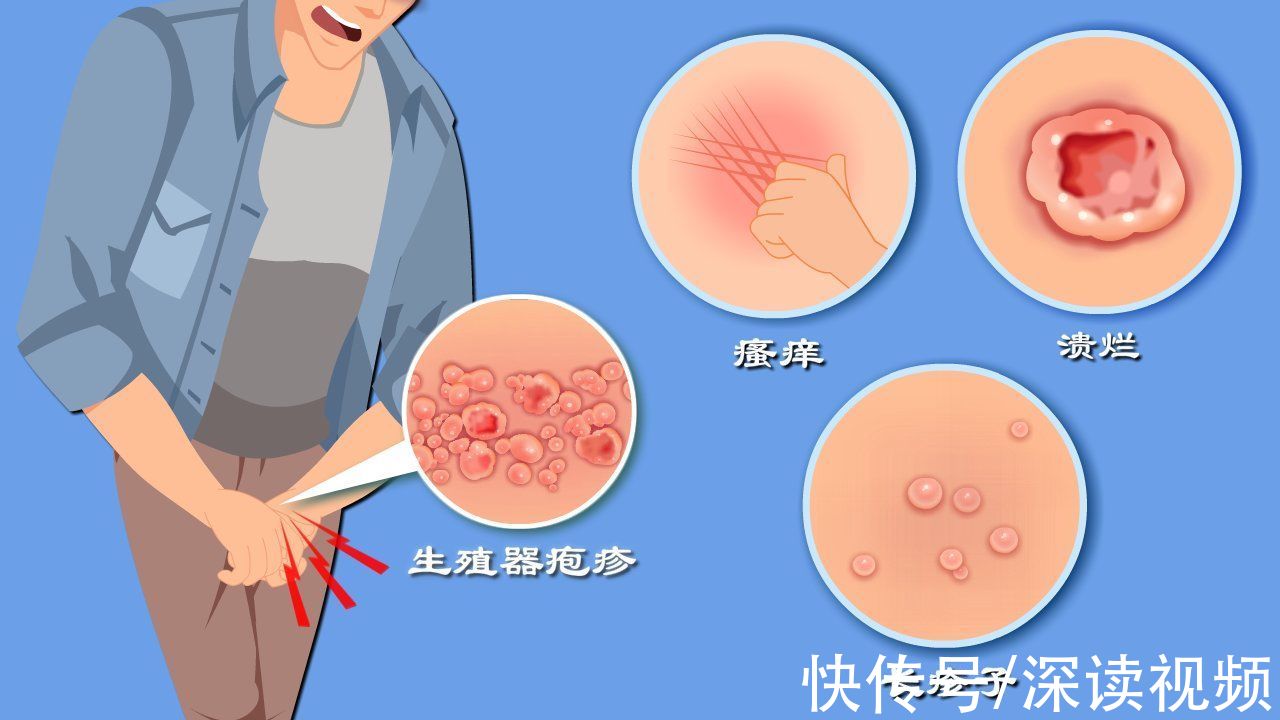疱疹|私处长疹子？瘙痒？生殖器疱疹发病率逐年上升，这些症状你有吗？
