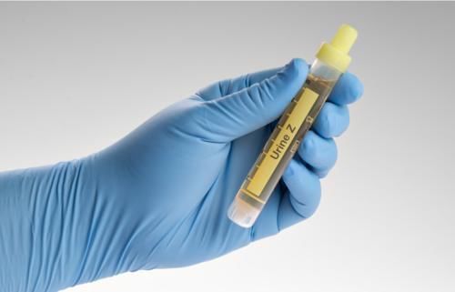 老大哥|65岁男士无痛血尿就诊,医生庆幸:警惕性高,及时发现了早期癌症