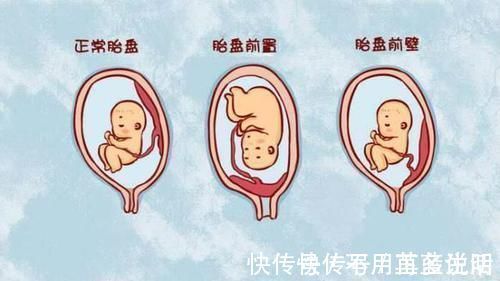 后壁|胎儿前壁好还是后壁好,胎盘前壁优劣势各有两点,孕早期早知道