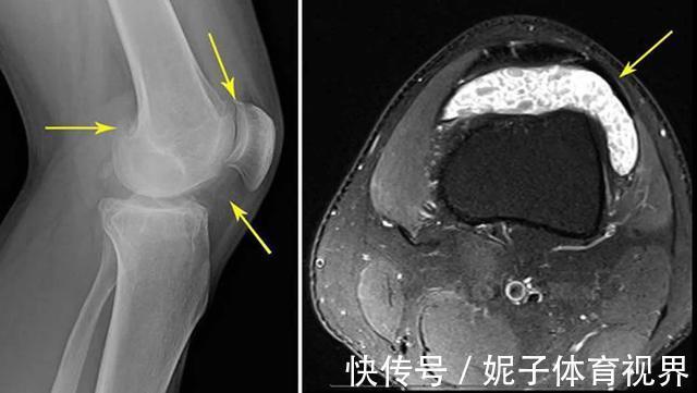 患者|膝盖疼，就是得滑膜炎了？医生辟谣，教您一步步判断自己的病因