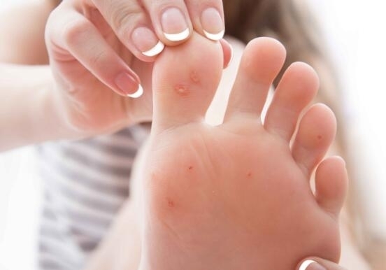 瓜状趾|脚部一旦出现这4种异常,可能是糖尿病,马上查血糖,别忽视