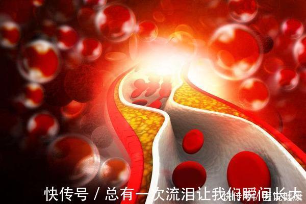 血栓|脑梗来势汹汹？告诫：这4种行为是脑梗的“催化剂”，早改才好