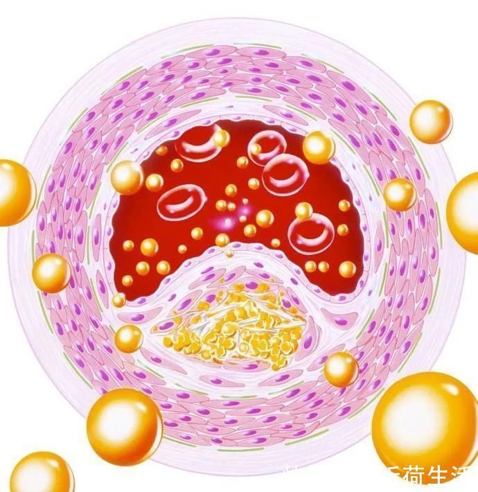 脂蛋白颗粒|血脂报告中除了“坏”胆固醇,还应该关注什么?