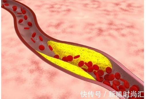 血症|高血脂不疼不痒无需在意?辟谣:高血压长期不控制会导致这些疾病