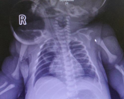 新生儿先天性巨大颈部肿物成功手术,家长为医护人员送来别样礼物