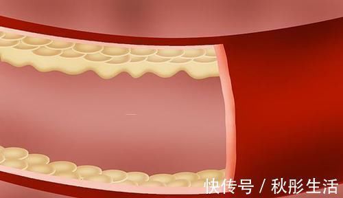 胆固醇|天天吃鸡蛋会加速血管堵塞吗 鸡蛋到底能不能天天吃 医生告诉你