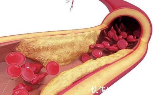 葛根条|血脂高的人，不想血管堵死，拿它煮水一喝，畅通血管，胜过降脂药