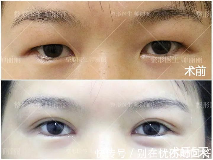 瘢痕 双眼皮术后出现肉条的不同原因和修复方法