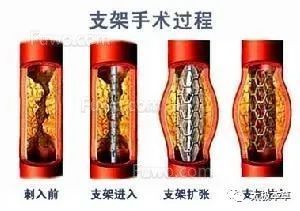 支架|冠心病,心脏支架搭一个又一个,照样犯,不如用中药来试试