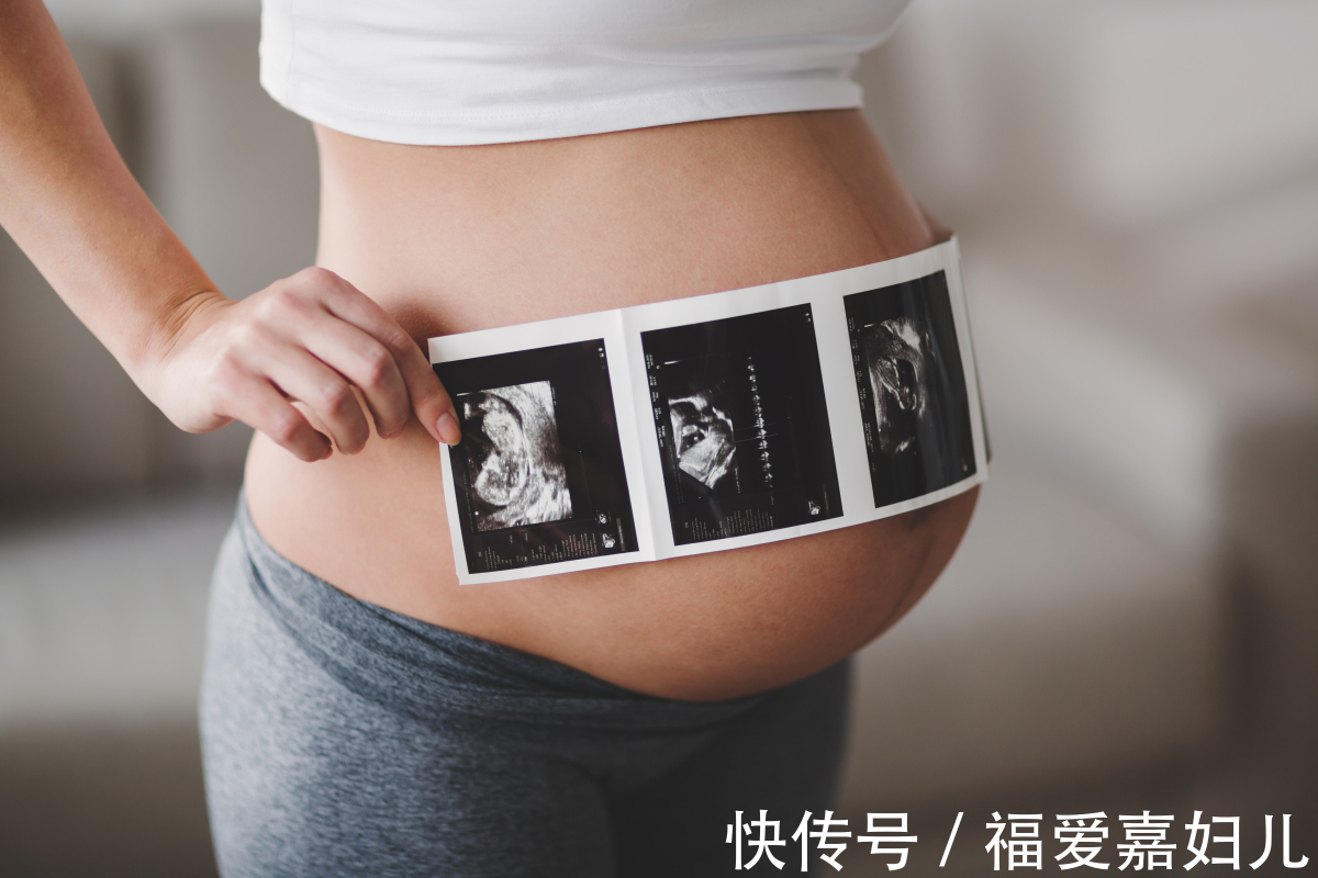 染色体|NT增厚的宝宝还能要吗?