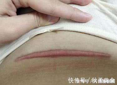 侧切|同样是“一刀”,侧切和剖腹产区别有多大?这7大区别你未必想得到
