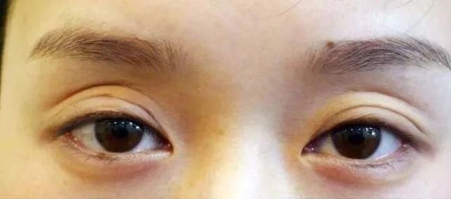 面部凹陷太显老，想要变回少女脸，你得这样做！