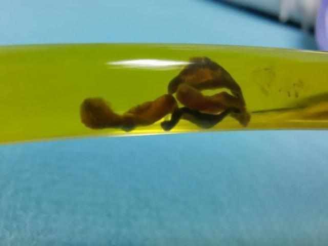 穿刺胆道|吓人男子胆汁里竟发现虫子只因吃了这个……