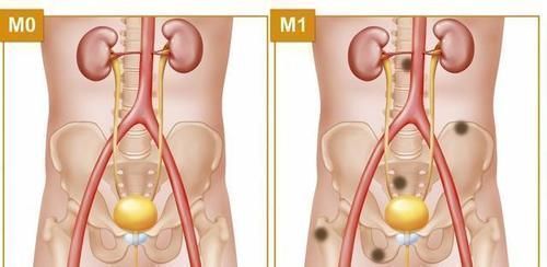 血尿|前列腺的“大救星”被发现，不是苹果，喝水加一点，炎症被赶走了
